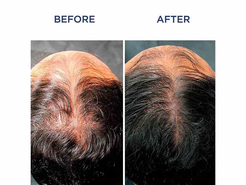 سرم مو فیتوسیان | مخصوص آقایان