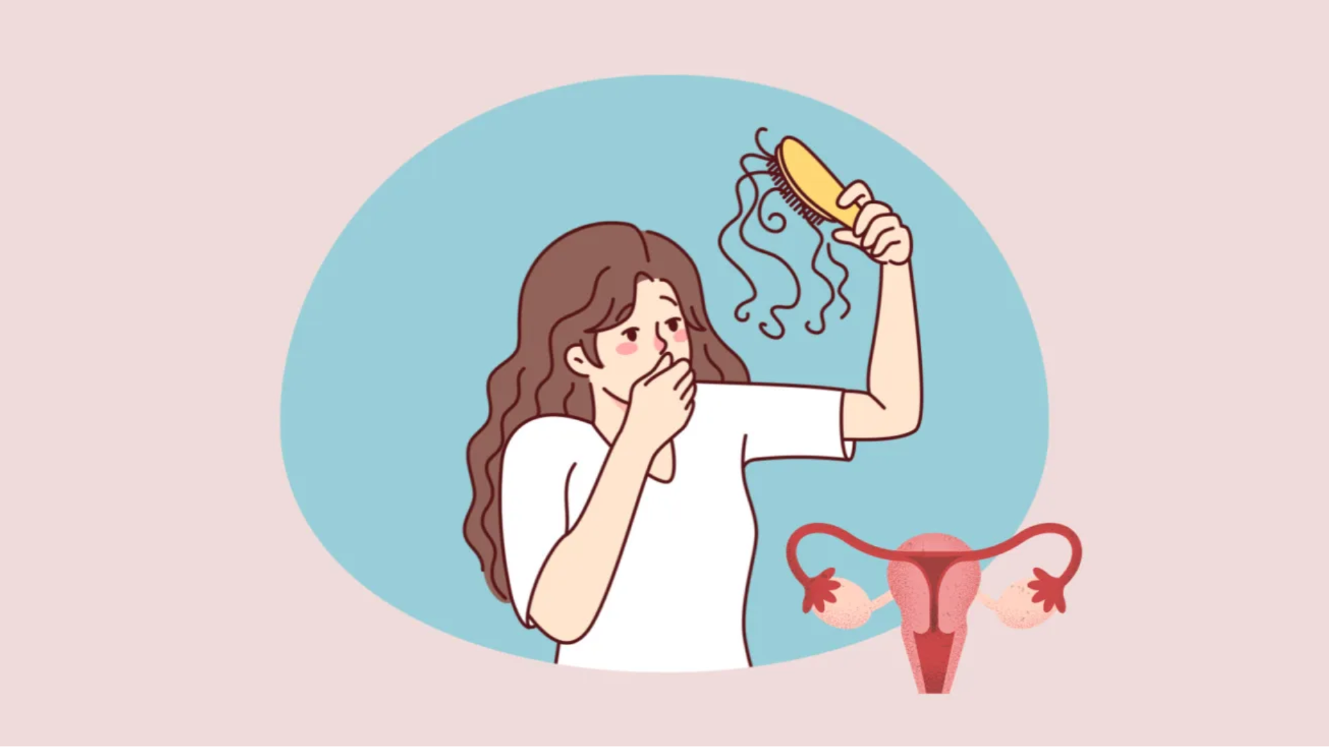 PCOS تخمدان پلی کیستیک و ریزش مو